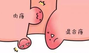 为什么会长痤疮，什么原因造成长痔疮？