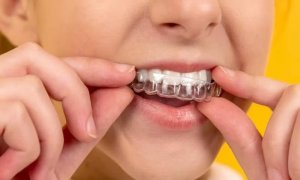 什么情况下需要给孩子进行牙齿矫正？乳牙期就要开始牙齿矫正吗？
