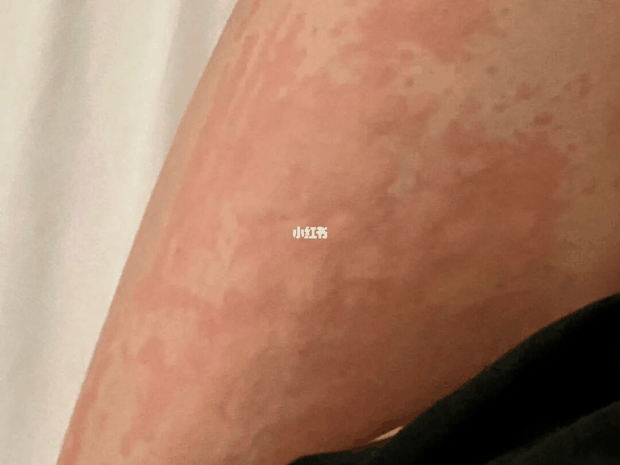 宝宝得荨麻疹是什么原因造成的？