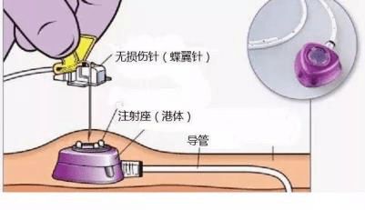 外周静脉输液通路及输液工具