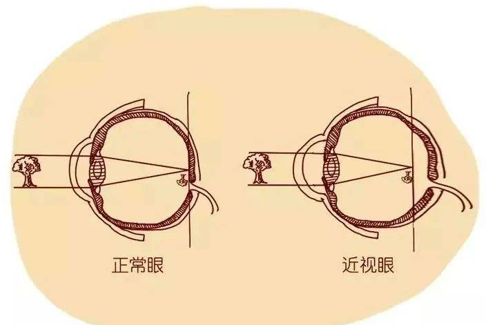 幼儿近视近视怎么办?能纠正吗